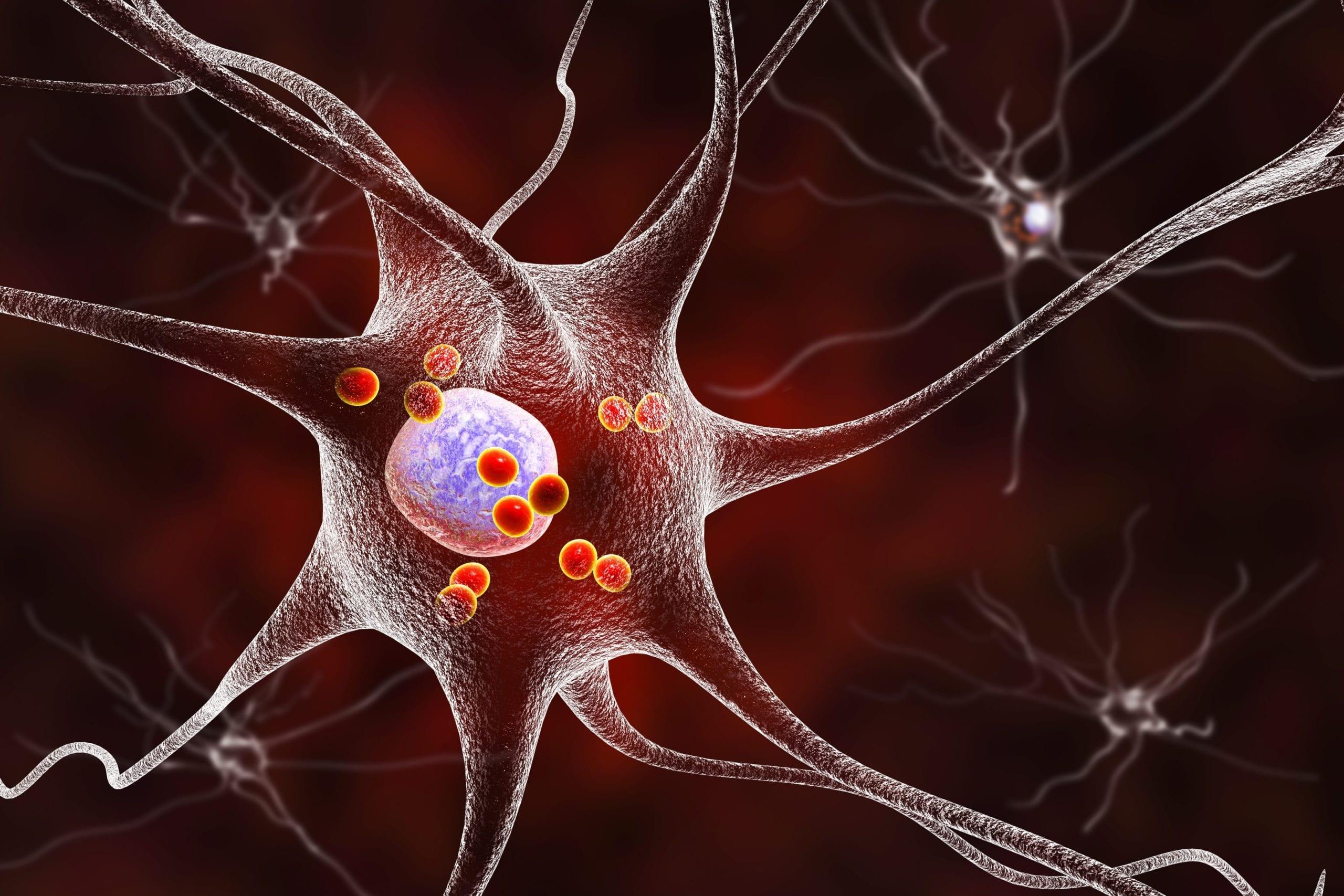 Cell model of Parkinson’s disease